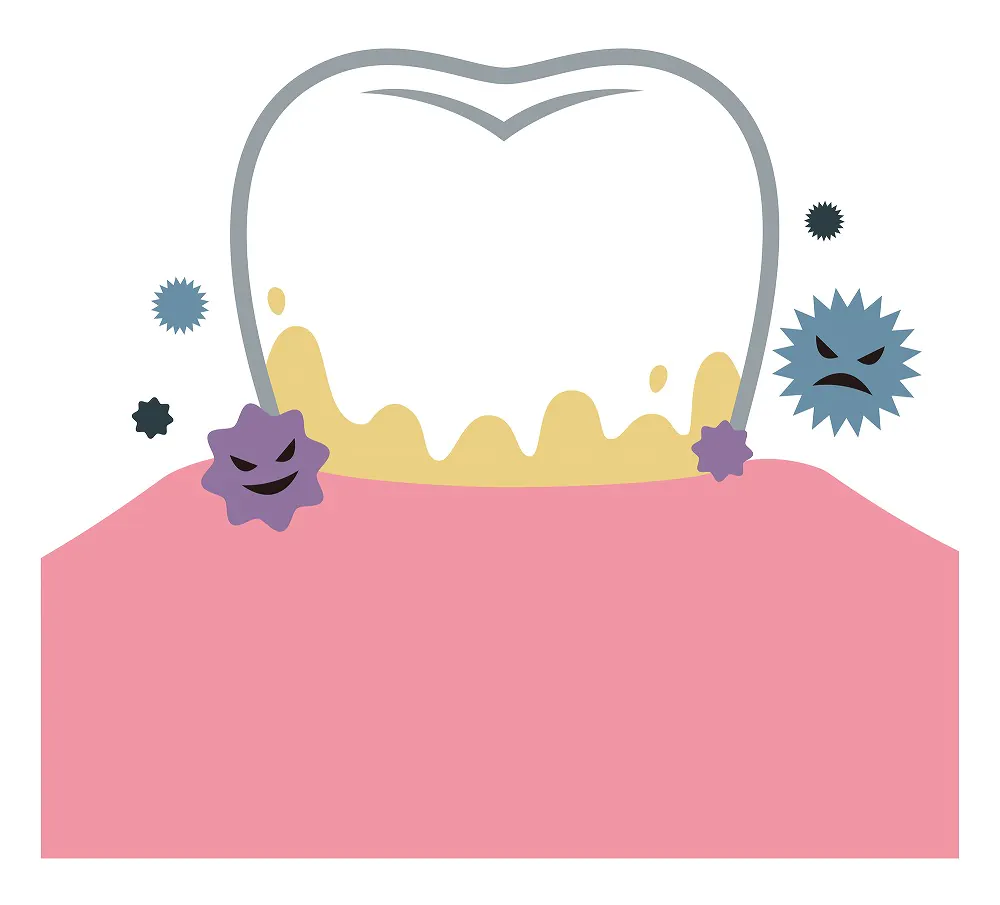 早期発見・早期治療が大切なむし歯