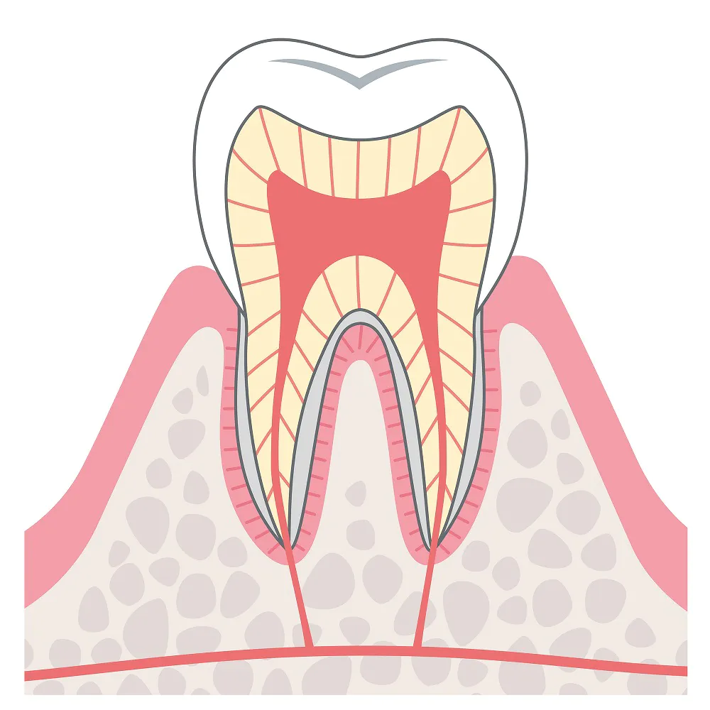 エナメル質の浅いむし歯（CO）