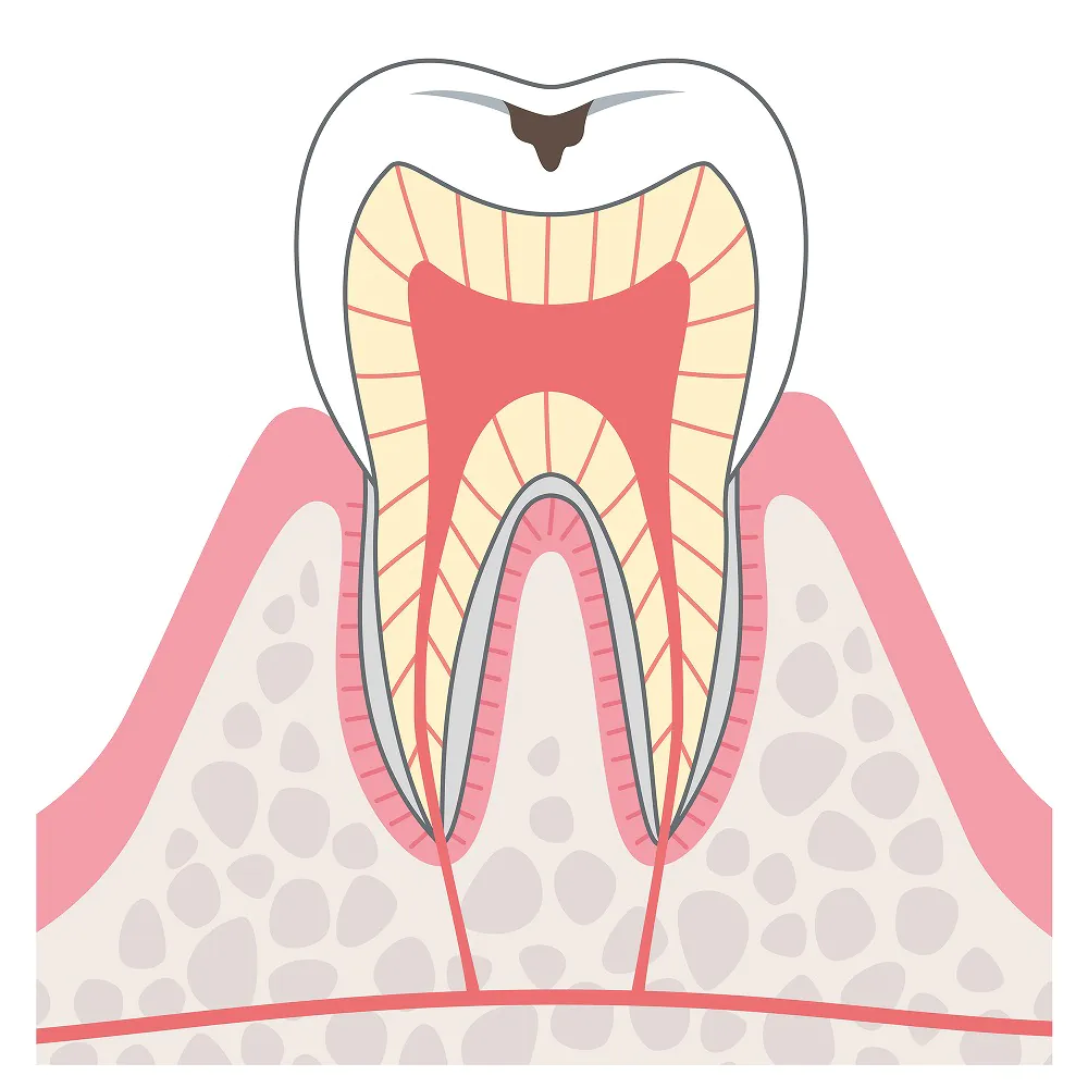 エナメル質の少し深いむし歯（C1）