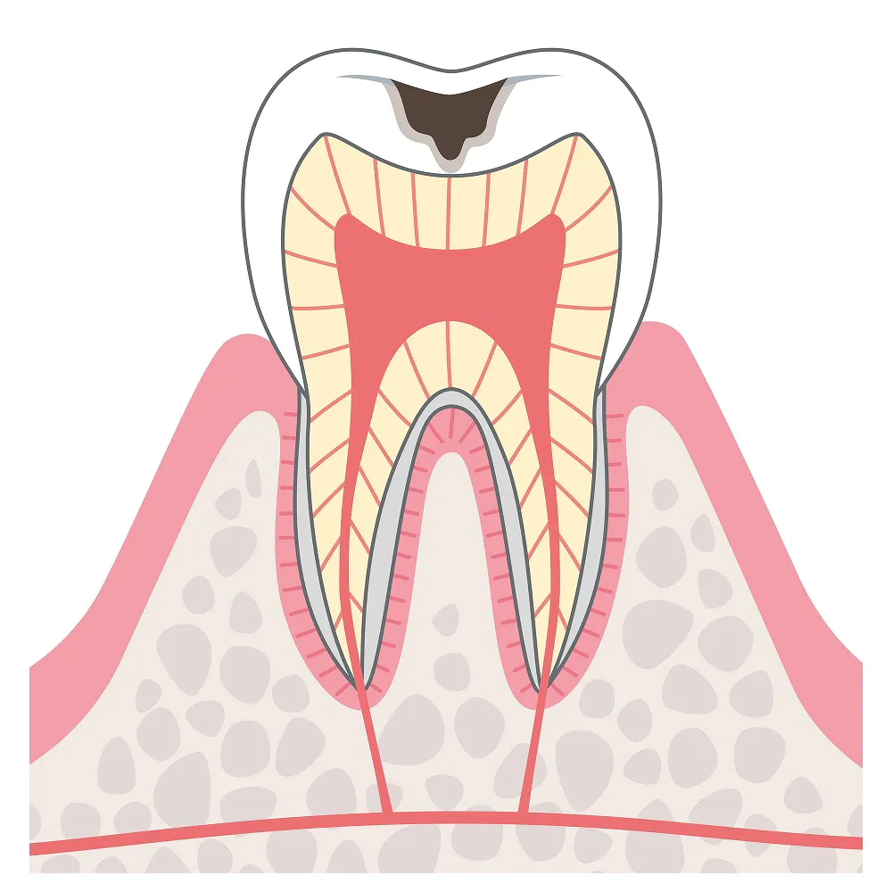 象牙質に達したむし歯（C2）