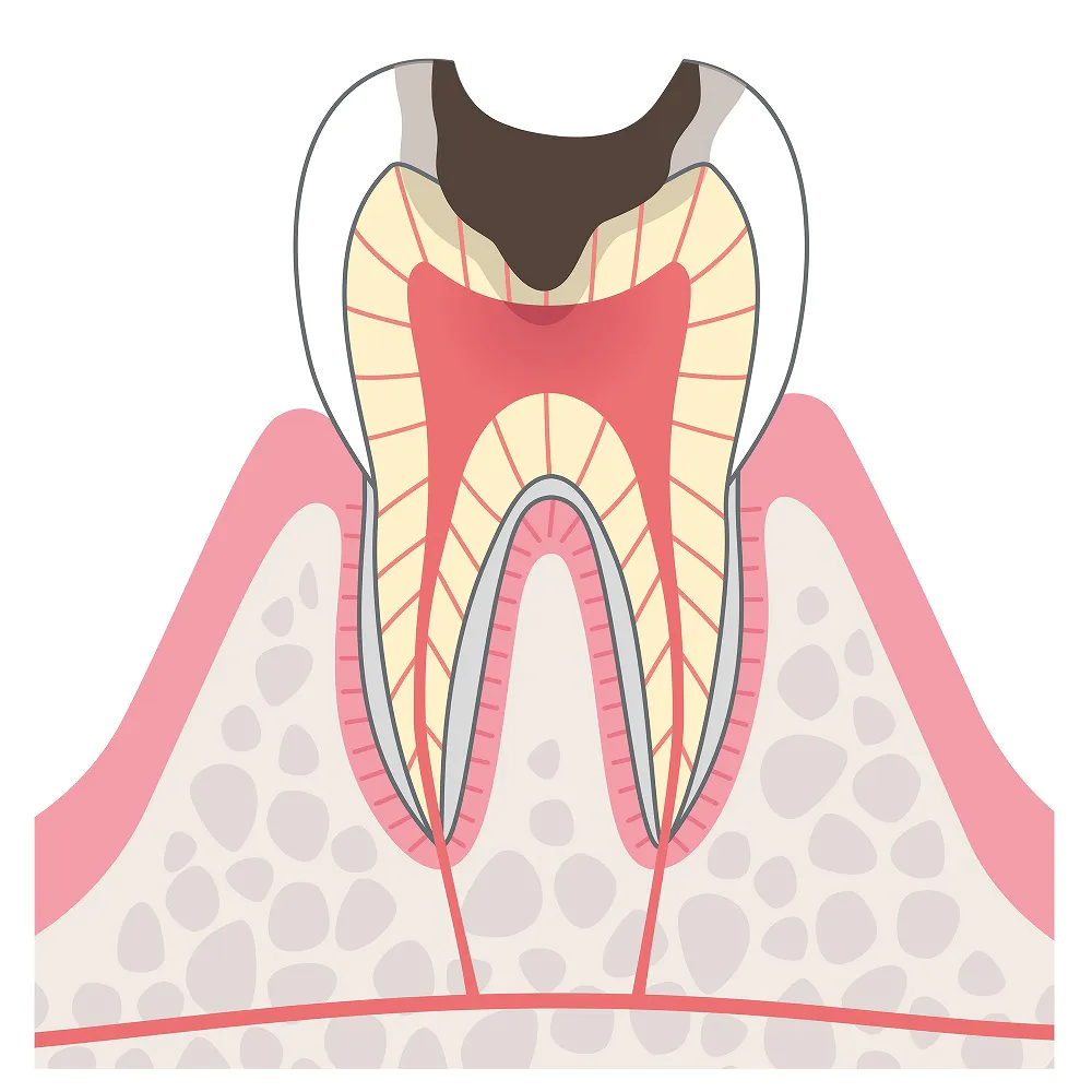 歯髄に達するむし歯（C3）
