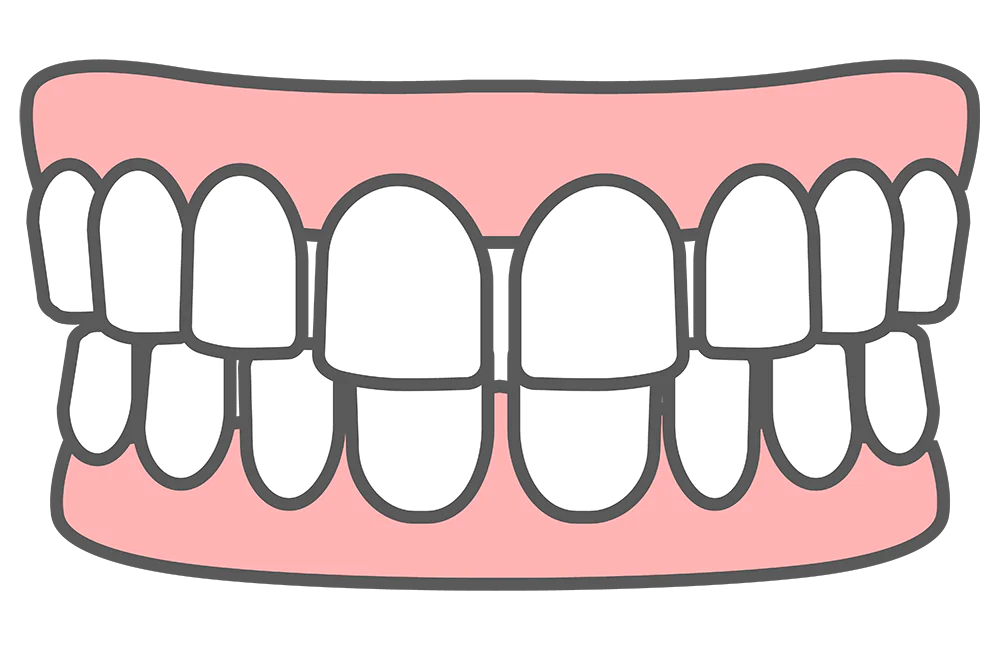 空隙歯列