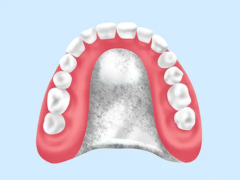 レジン床義歯