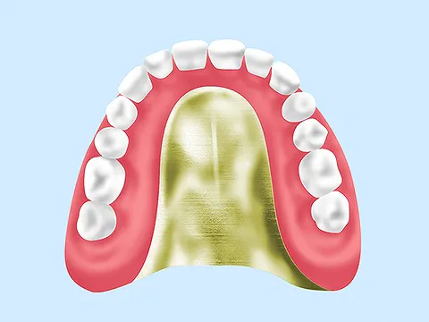 金属床義歯（チタン・コバルトクロム）