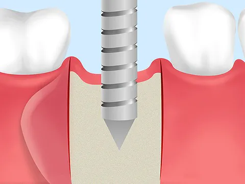 1次手術（インプラント埋入手術）