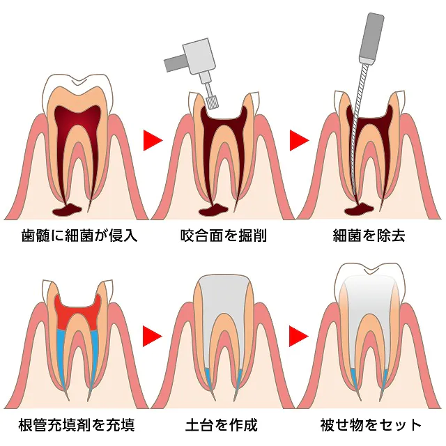 歯を残せる可能性がある「根管治療」