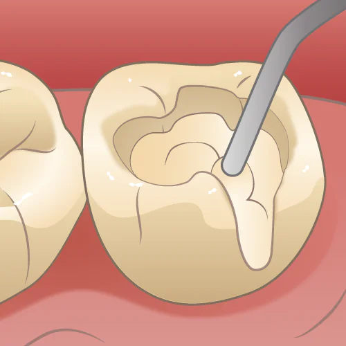 むし歯・歯周病治療