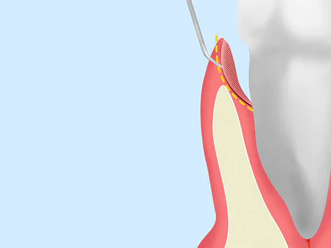 歯周ポケット掻爬（そうは）術
